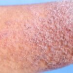 Why Is Opzelura Cream So Expensive? A Medical and Economic Breakdown